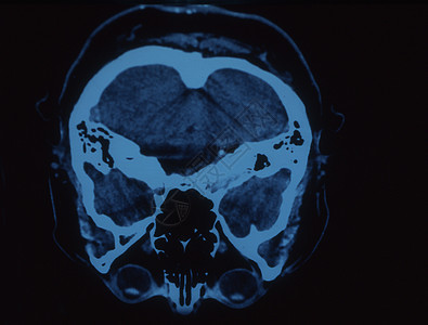 X射线图像中的脑部射线头骨鼻子考试科学小脑断层大脑皮层扫描x光图片
