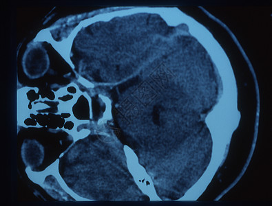 X射线图像中的脑部小脑扫描射线断层科学大脑皮层考试头骨x光鼻子图片