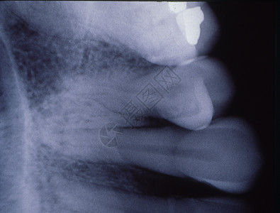 装有填料和桥梁的牙齿X光图像组织牙列牙龈馅料牙根搪瓷考试牙科牙医x光图片