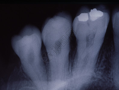 装有填料和桥梁的牙齿X光图像诊断牙医海豹考试牙根牙龈x光牙列馅料牙科图片