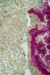 显微镜下活性肿瘤疾病 100x组织学药品诊断考试病理科学医生细菌组织细胞图片