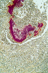 显微镜下活性肿瘤疾病 100x细菌医生组织学诊断考试细胞病理科学药品组织图片