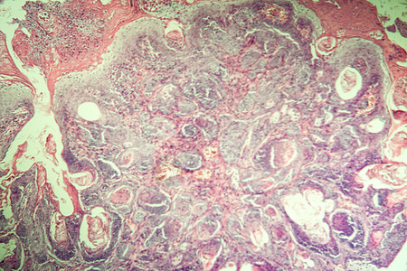 白鼠和100头组织中的癌细胞瘤宏观疾病诊断科学组织学药品康复考试专用老兵图片