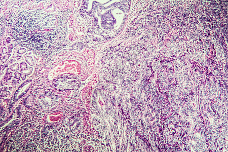 组织第100节组织内胃癌组织学药品宏观科学病理疾病消化治愈制剂癌症图片