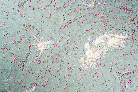 显微镜下的肾组织内嵌入凝胶晶体药品病理疾病科学水晶组织学存款诊断痛风考试图片