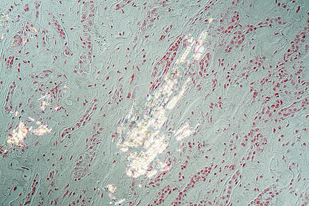 显微镜下的肾组织内嵌入凝胶晶体水晶疾病诊断考试病理宏观存款科学药品痛风图片