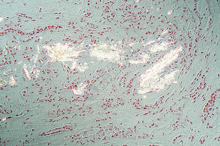 显微镜下的肾组织内嵌入凝胶晶体诊断药品存款痛风水晶科学宏观疾病考试组织学图片