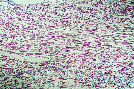 心脏肌肉发炎 作为心肌炎100x心肌科学宏观疾病病理药品诊断组织考试组织学图片