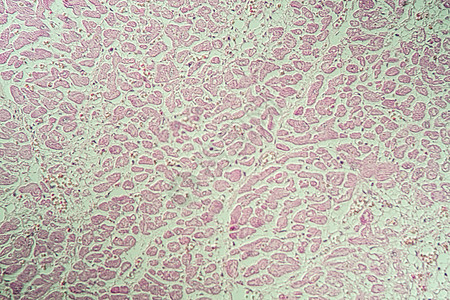 显微镜下发炎的心脏肌肉病组织 200x考试组织学宏观心肌诊断病理药品疾病科学心脏病图片