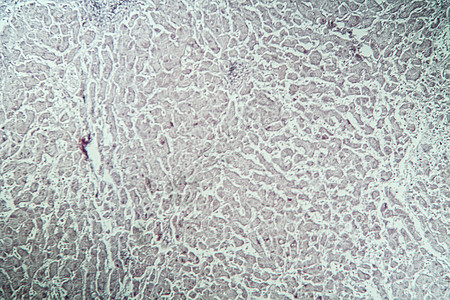 显微镜下病组织肝炎标记100x科学抗原标志物康复疾病药品组织学考试病理诊断图片