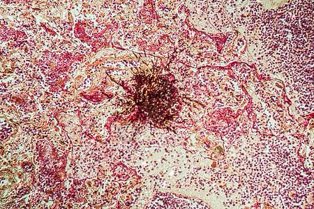 Candida和Aspergillus感染艾滋病病人的肺炎 20康复药品养护疾病诊断调查酵母病理组织学宏观图片