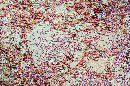 Candida和Aspergillus感染艾滋病病人的肺炎 20康复药品酵母病理诊断调查科学养护疾病组织学图片