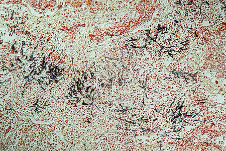 Candida和Aspergillus感染艾滋病病人的肺炎 20病理酵母疾病诊断组织学药品宏观科学养护调查图片