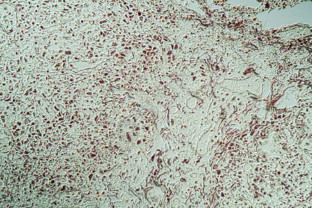 Candida和Aspergillus感染艾滋病病人的肺炎 20酵母科学药品康复组织学病理疾病养护调查诊断图片