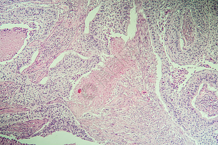 显微镜下鳞状细胞癌病变组织 100诊断病理宏观考试癌症科学药品细胞疾病组织学图片