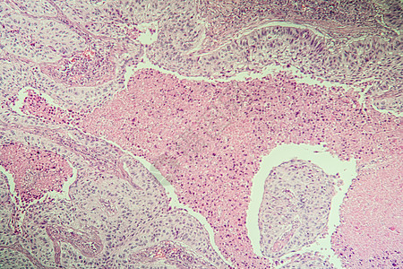 显微镜下鳞状细胞癌病变组织 100病理科学诊断药品疾病考试宏观组织学癌症细胞图片