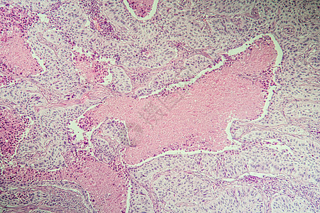 显微镜下鳞状细胞癌病变组织 100疾病组织学药品病理科学诊断细胞癌症考试宏观背景图片