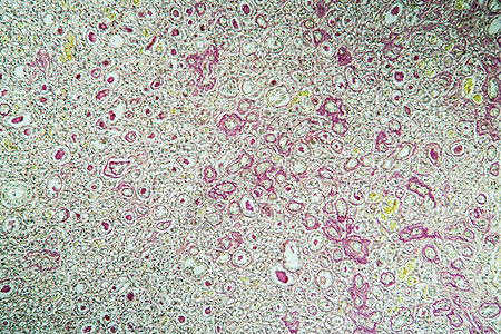 显微镜下的肾脏病组织萎缩 100x诊断病理细胞肾脏药品肾小球宏观肾炎组织学疾病图片
