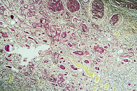 显微镜下的肾脏病组织萎缩 100x科学病理药品诊断肾炎肾小球肾脏疾病考试细胞图片