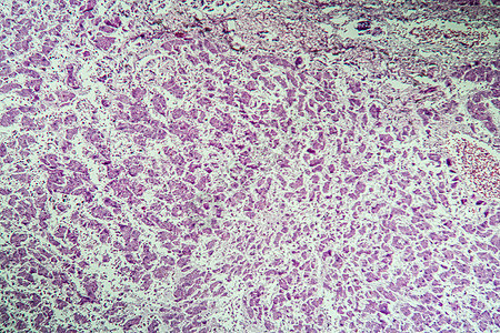 100x 显微镜下的活性肿瘤病组织疾病科学宏观病理组织学癌症诊断考试药品图片