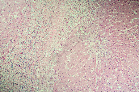 100x 显微镜下的肝硬化发病组织诊断组织学考试癌症科学疾病药品病理宏观图片