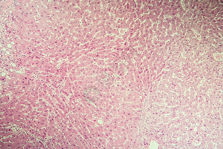 100x 显微镜下的肝硬化发病组织诊断科学组织学病理考试药品癌症宏观疾病图片