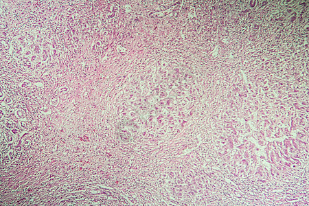 100x 显微镜下的肝硬化发病组织中毒病理药品癌症毒理学诊断宏观疾病组织学科学图片