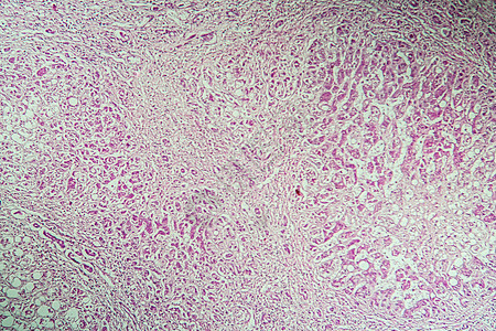 100x 显微镜下的肝硬化发病组织病理科学组织学考试中毒诊断宏观药品毒理学疾病图片