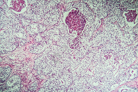 显微镜下卵巢疾病组织癌症 100x考试病理细胞组织学科学诊断宏观药品图片