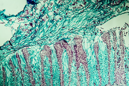 显微镜下冠癌组织 100x药品组织学疾病检查诊断科学医生康复囊肿细胞图片