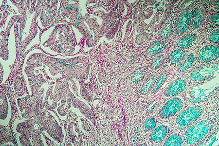显微镜下冠癌组织 100x薄片疾病考试组织学医生病理囊肿宏观药品群落图片