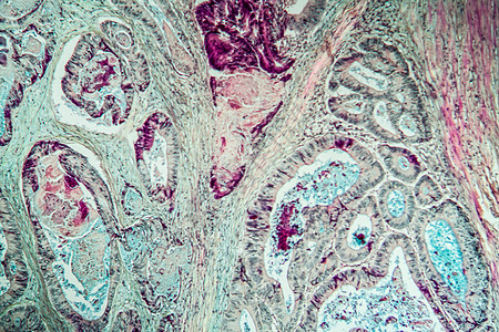 Colon 癌原组织稀薄100分薄片宏观科学诊断药品病理囊肿群落检查疾病图片