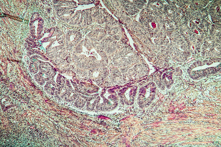 Colon 癌原组织稀薄100分宏观薄片组织学细胞囊肿病理医生康复群落科学图片