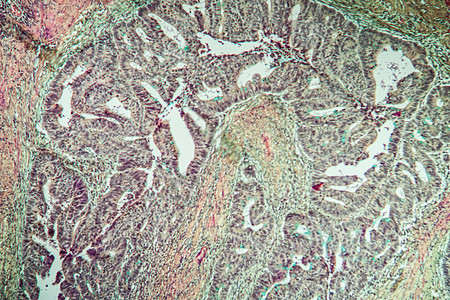 Colon 癌原组织稀薄100分科学医生考试药品囊肿群落细胞薄片疾病组织学图片