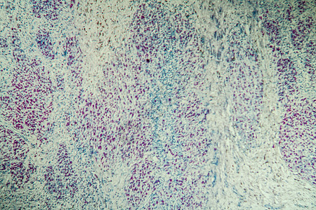 具有真菌100x感染组织的艾滋病薄片缺陷免疫组织学康复考试细菌诊断宏观科学图片