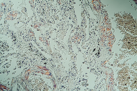 显微镜下病组织氨基菌状体积的肺部药品疾病康复蛋白存款科学组织薄片病理宏观图片