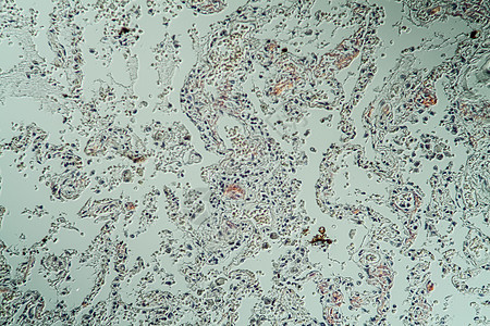 显微镜下病组织氨基菌状体积的肺部组织学宏观医生诊断薄片蛋白存款组织药品疾病图片