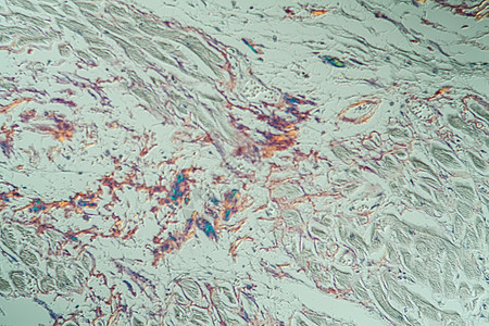 显微镜下病组织氨基亚胺质储存宏观蛋白医生科学考试药品诊断细胞组织学病理图片