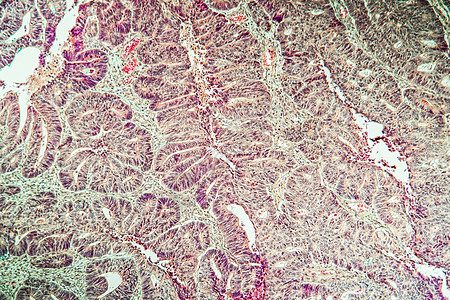腺瘤引起的冠癌 100x组织学癌症诊断薄片考试药品宏观疾病组织大肠图片
