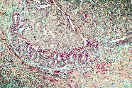 腺瘤引起的冠癌 100x科学诊断考试组织学薄片药品癌症细胞组织病理图片