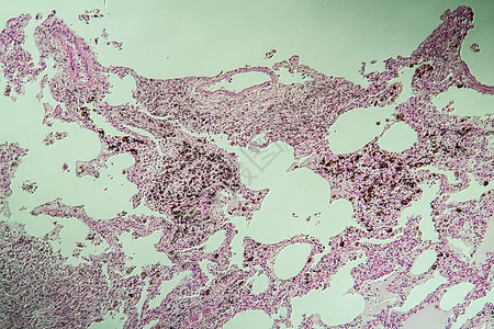 肺组织作为显微镜下的粉尘肺 100x疾病科学薄片药品微尘组织学细胞肺部肺炎病理图片