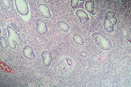 克罗恩病的科朗炎病理细胞组织薄片宏观组织学生物学药品科学疾病图片