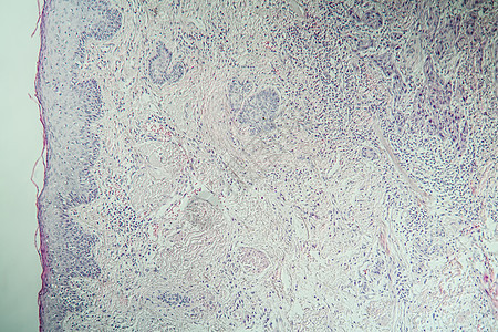 皮肤溃疡癌增加100倍组织细胞宏观放大镜薄片药品生物学嘴唇组织学科学图片