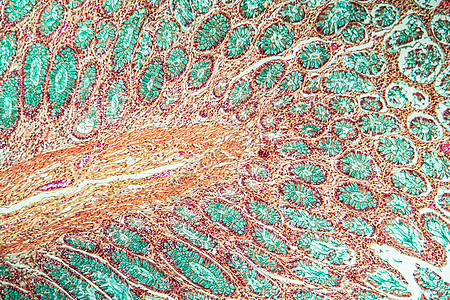 第1节 肿瘤组织组织部分 1 含有葡萄和淋巴细胞的睾丸素增殖癌症药品生物学宏观绒毛病理薄片组织学科学图片