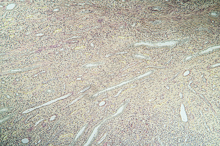 组织第100节中氢肾脏炎症组织学药品生物学细胞科学疾病宏观薄片病理肾炎图片