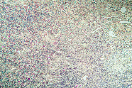组织第100节中氢肾脏炎症诊断细胞宏观放大镜科学病理疾病组织学药品肾炎图片