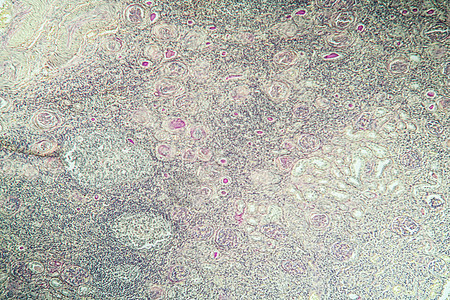 组织第100节中氢肾脏炎症诊断宏观肾炎组织学病理科学细胞药品薄片放大镜图片