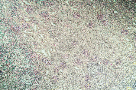 组织第100节中氢肾脏炎症组织学科学宏观疾病肾炎药品病理细胞放大镜诊断图片