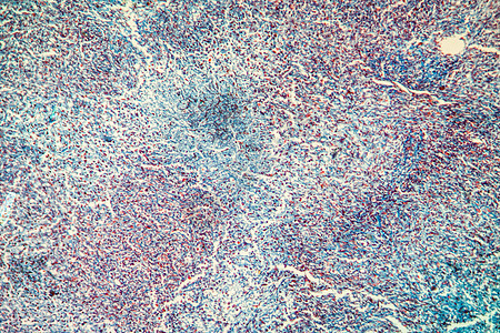 显微镜下胆囊组织癌症 100x100x科学细胞放大镜蓝色宏观病理疾病图片