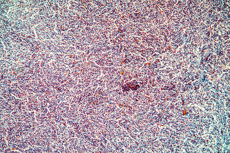 显微镜下胆囊组织癌症 100x100x病理科学放大镜疾病蓝色宏观细胞图片